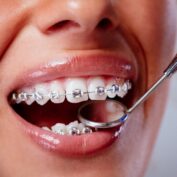 Unlocking Your Best Smile: The Importance of Professional Laser Teeth Whitening After Braces