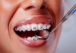 Unlocking Your Best Smile: The Importance of Professional Laser Teeth Whitening After Braces