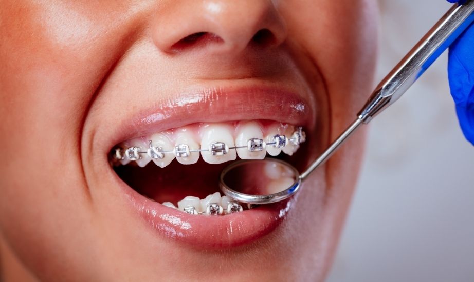 Unlocking Your Best Smile: The Importance of Professional Laser Teeth Whitening After Braces